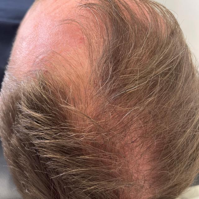 before PRF treatment