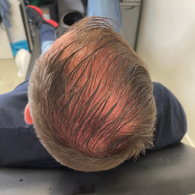 after PRF treatment