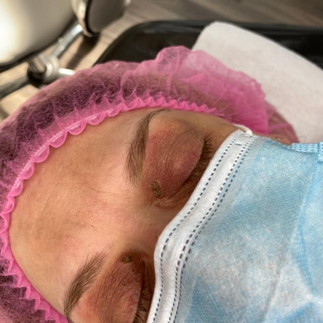 after Electrolysis