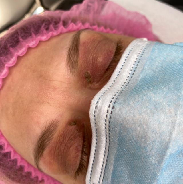 look after Electrolysis treatment