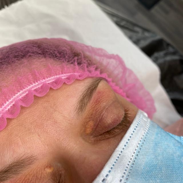 look before Electrolysis treatment