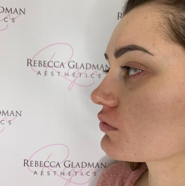 look before Filler Dissolving treatment