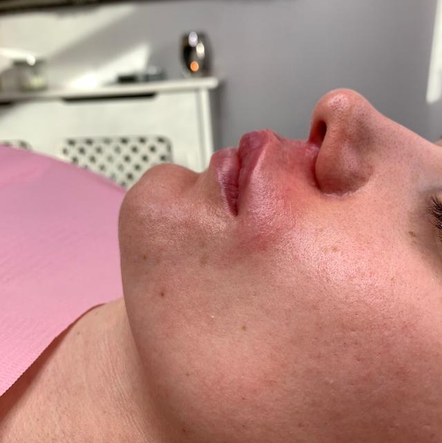 look after Filler Dissolving treatment