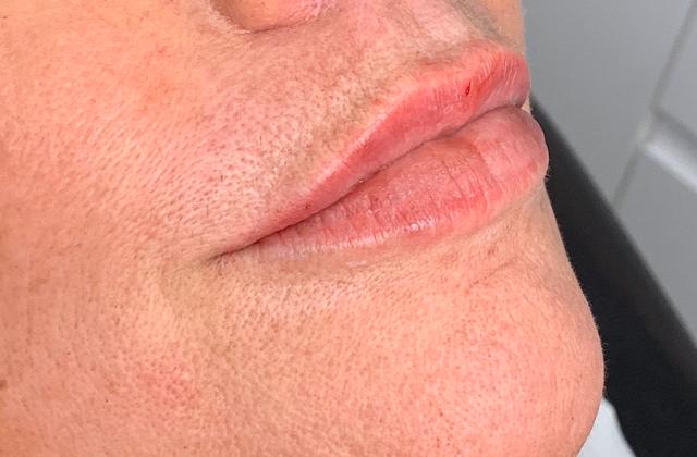 after Mesotherapy treatment