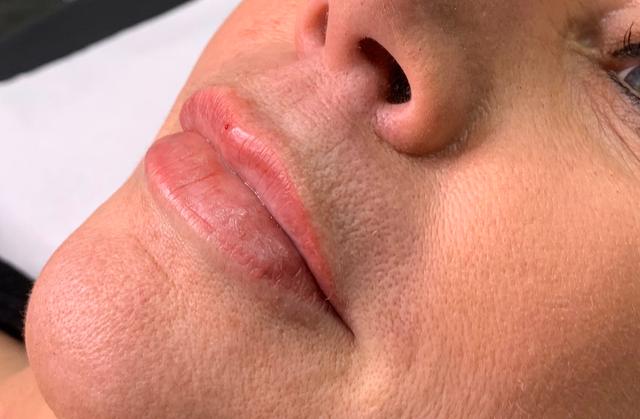 look after Mesotherapy treatment