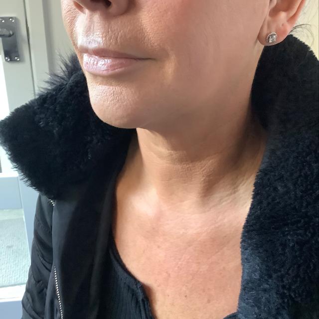 before Mesotherapy