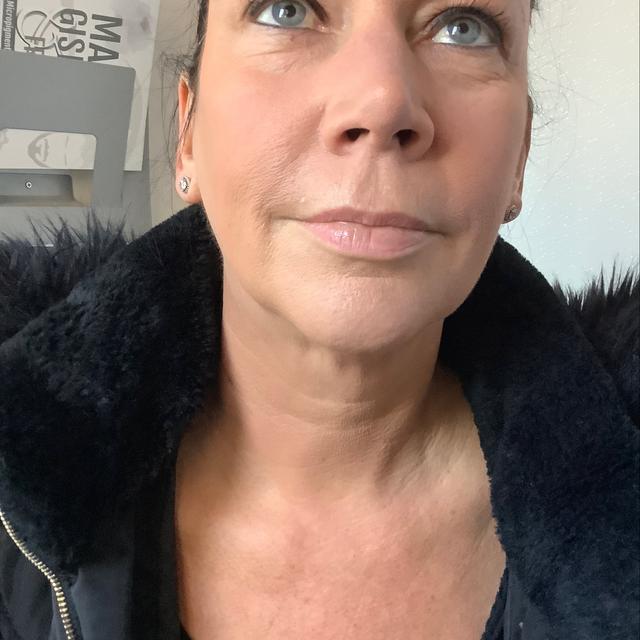 before Mesotherapy treatment