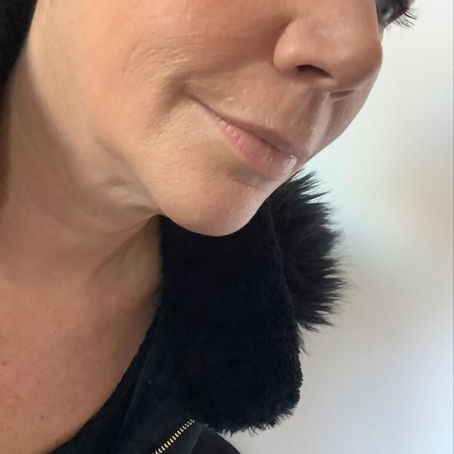 look before Mesotherapy treatment