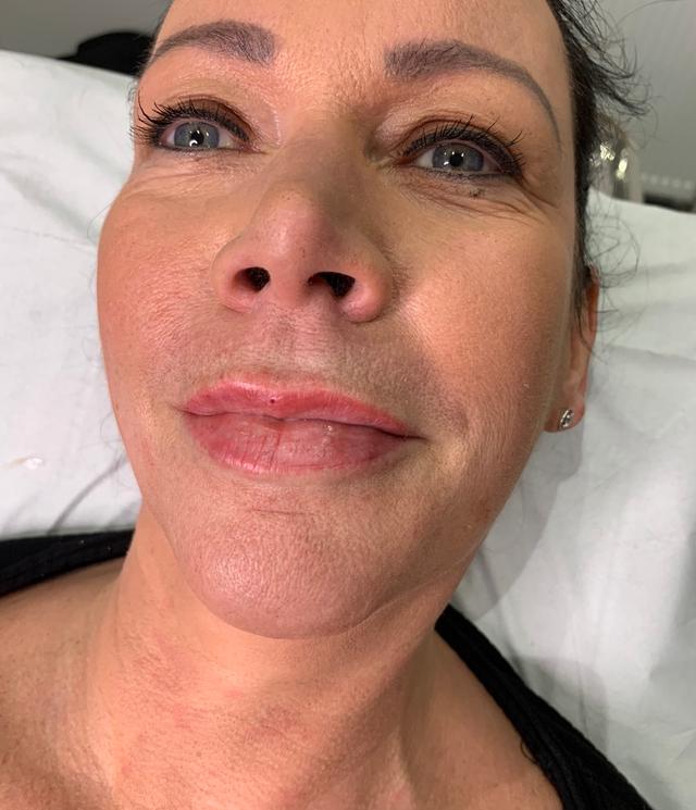 after Mesotherapy