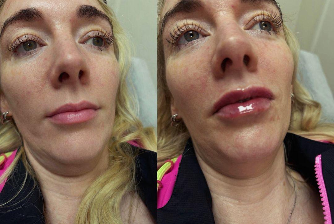 Clinical glow image 1