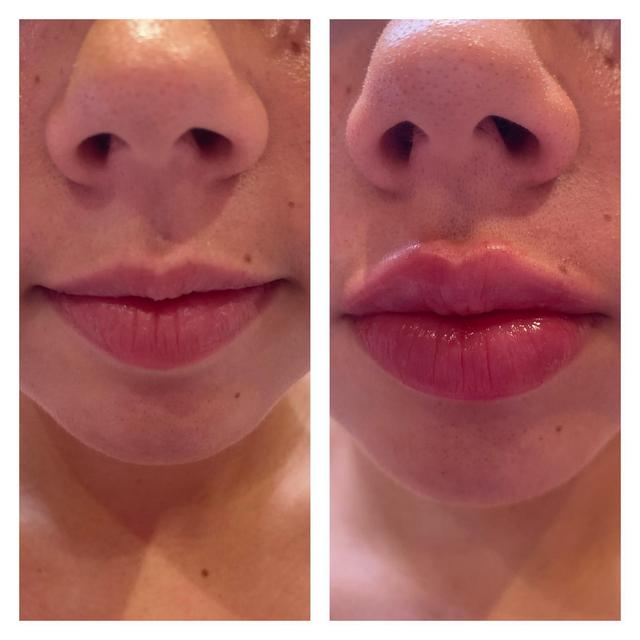 B12 Injection Near Me | Book Now | Faces B12 Injection Near Me | Book Now | Faces