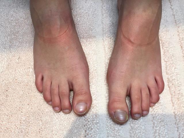before Pedicure