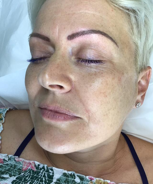 look after Cheek Filler treatment