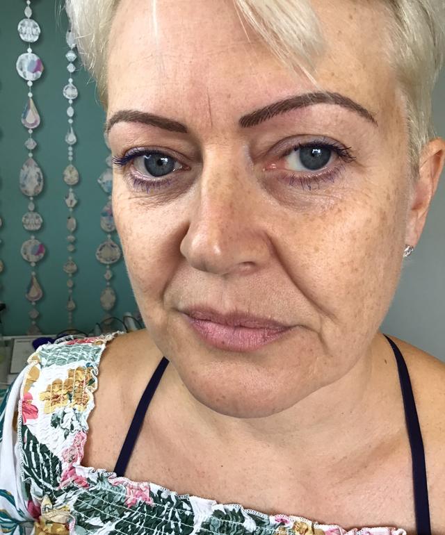 look before Cheek Filler treatment
