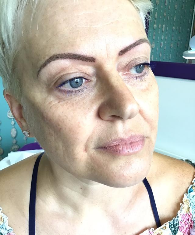after Cheek Filler treatment