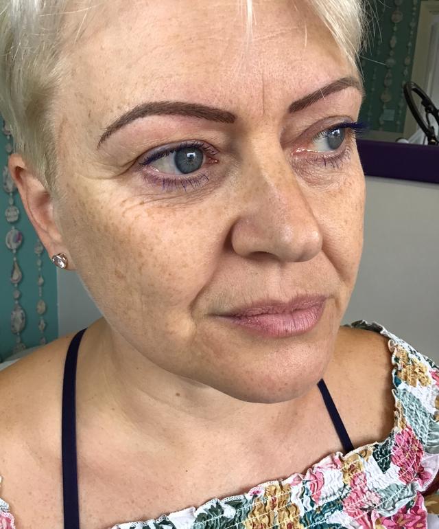 before Cheek Filler treatment