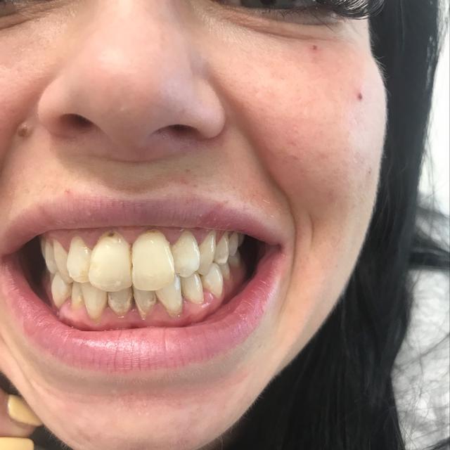 after Teeth Whitening treatment