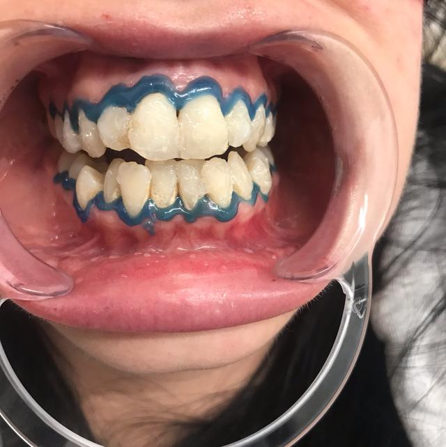 before Teeth Whitening treatment