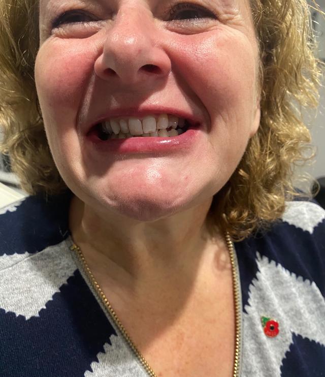 look after Teeth Whitening treatment
