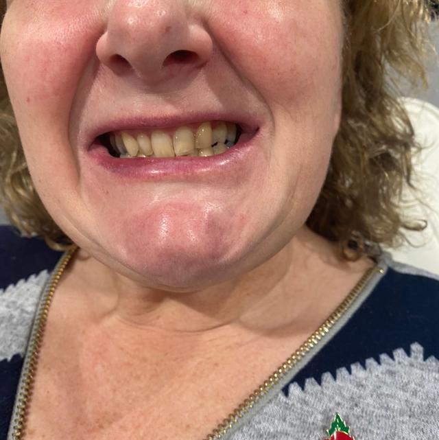 before Teeth Whitening