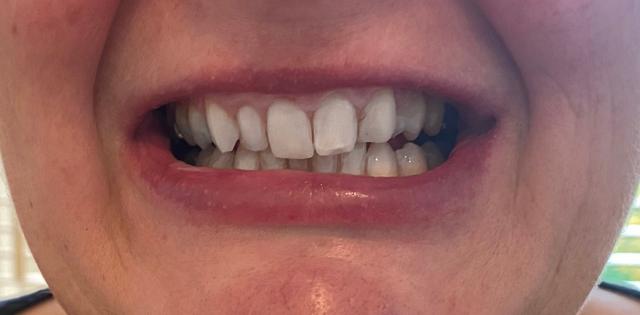 after Teeth Whitening