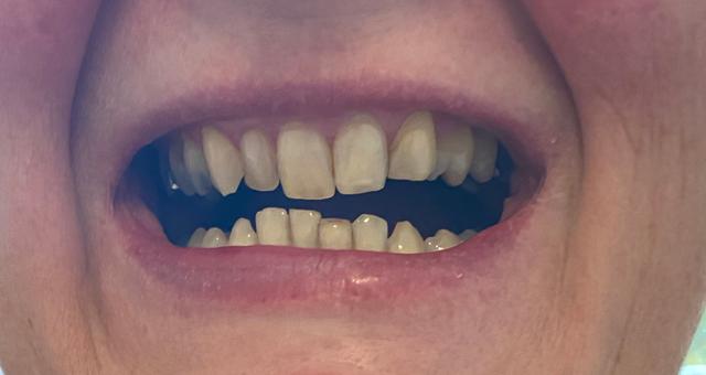 look before Teeth Whitening treatment