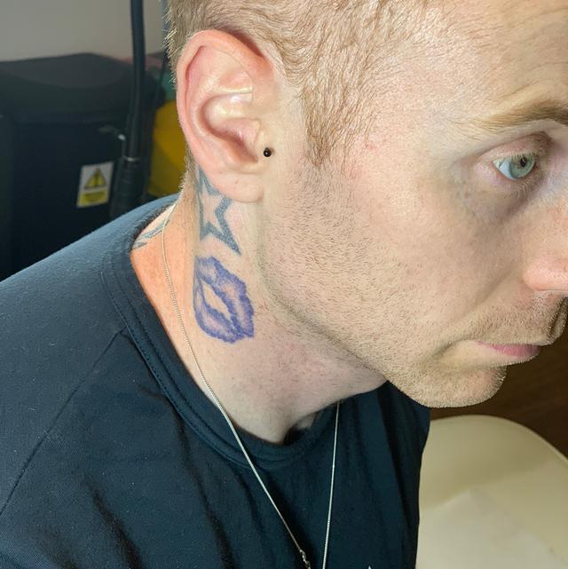 before Jaw Filler treatment