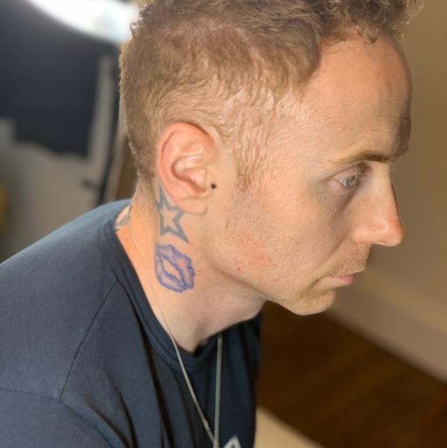 after Jaw Filler treatment