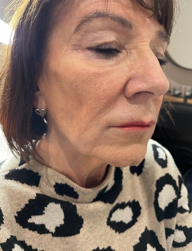 look before Jaw Filler treatment
