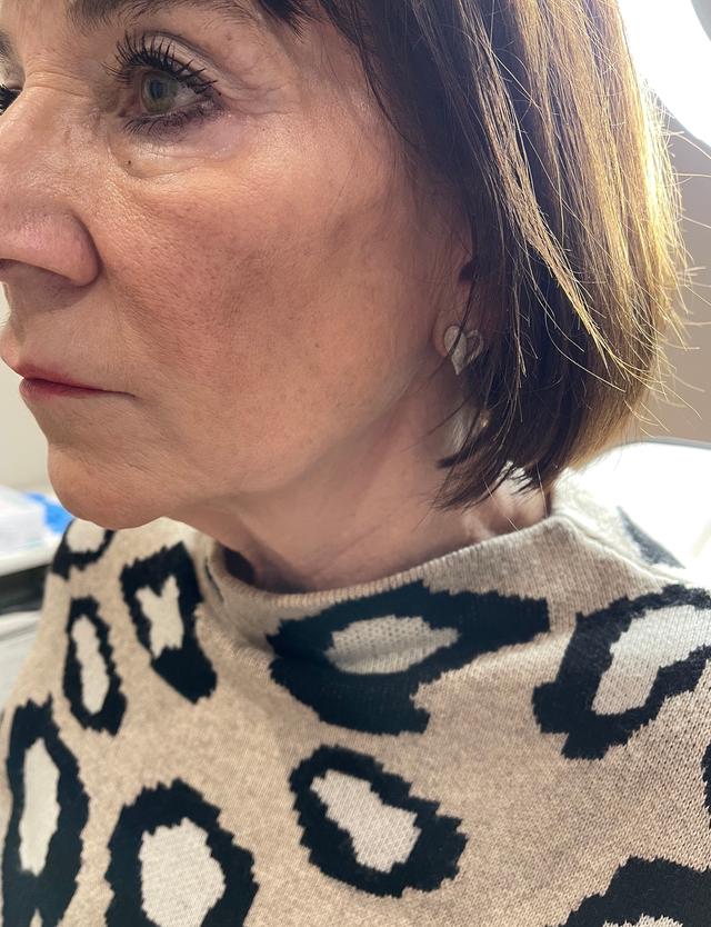 before Jaw Filler