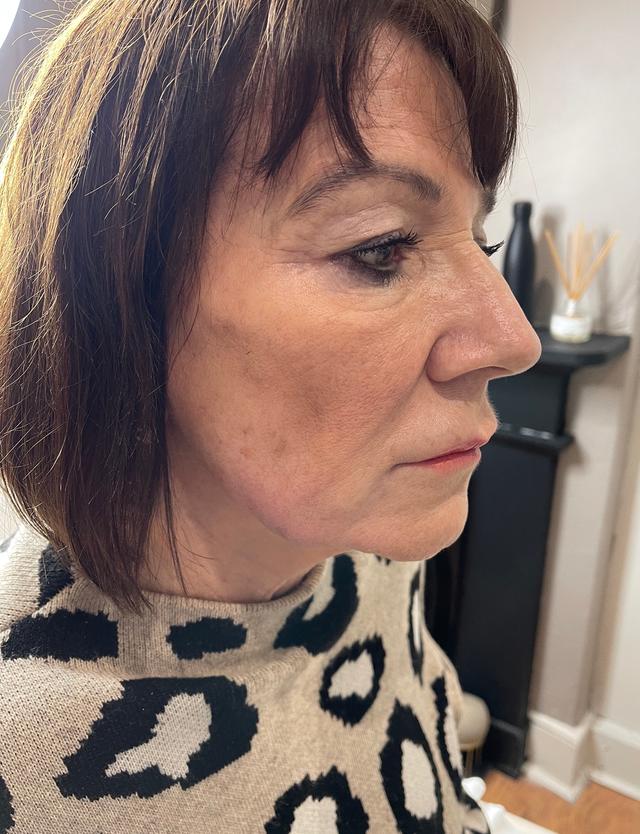 after Jaw Filler