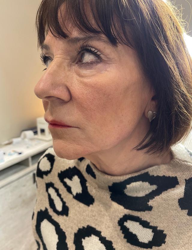 look after Jaw Filler treatment
