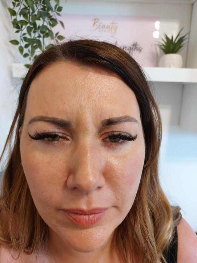 look after Anti-Wrinkle Injection treatment