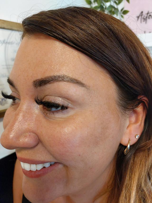 after Anti-Wrinkle Injection treatment