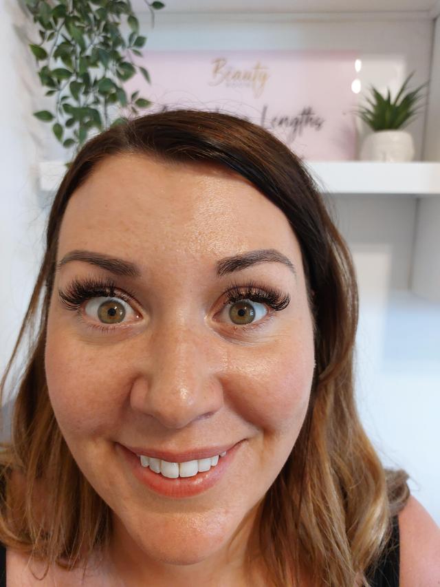 after Anti-Wrinkle Injection