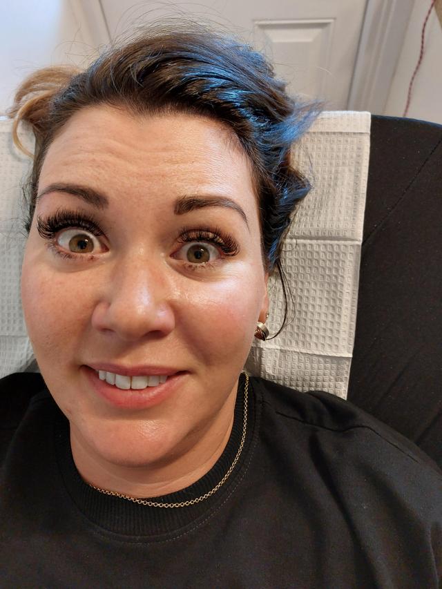 before Anti-Wrinkle Injection
