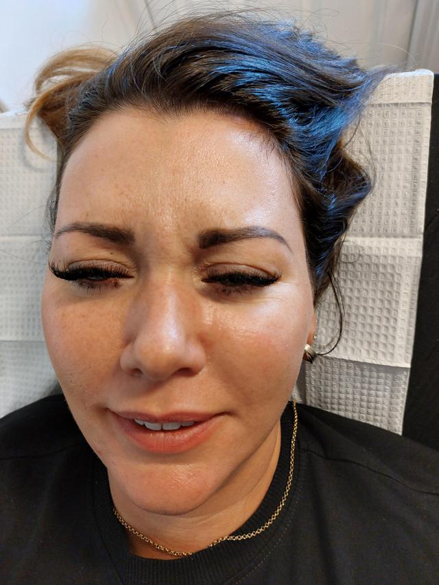 look before Anti-Wrinkle Injection treatment