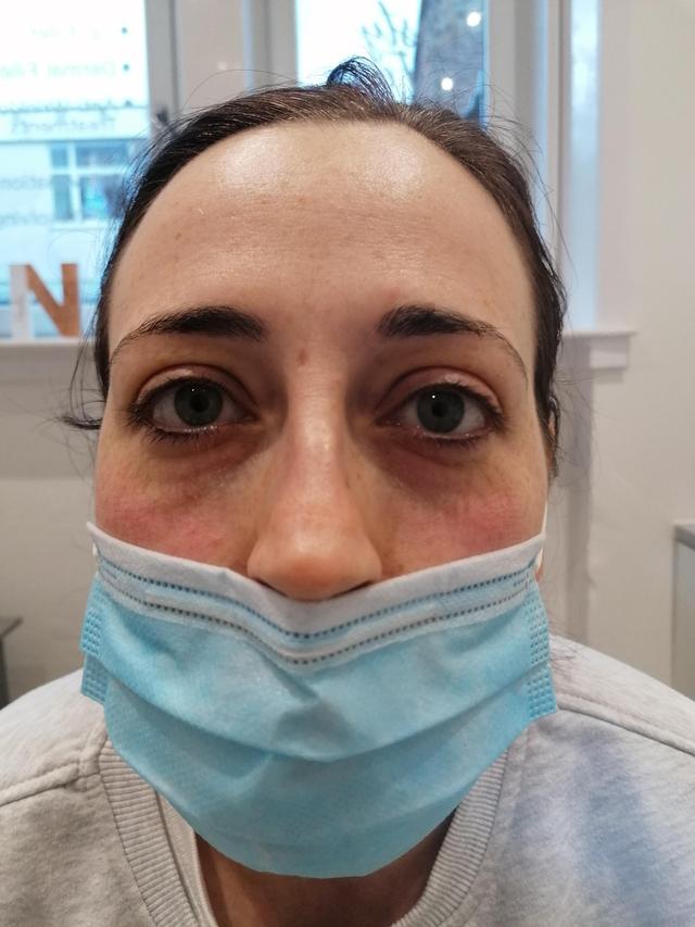 after Tear Trough Filler treatment