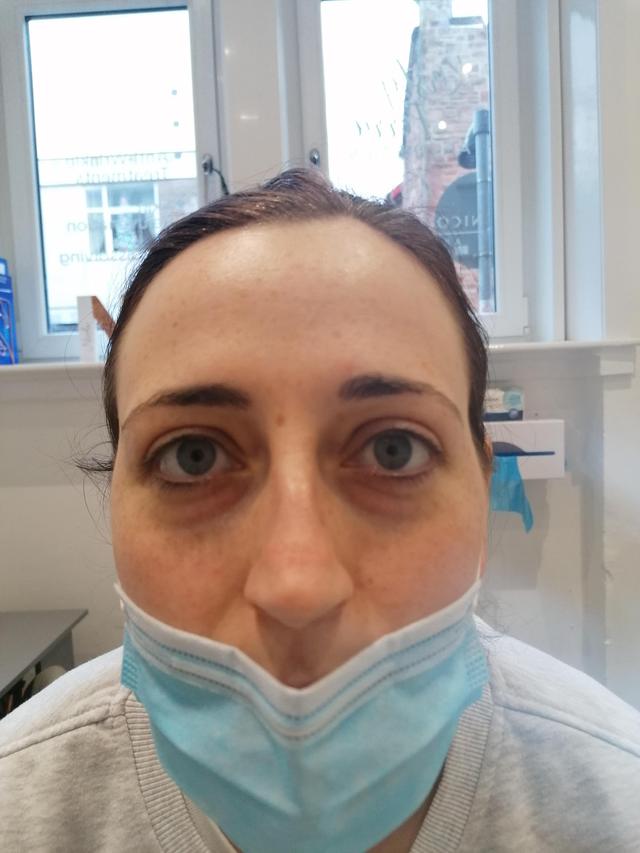 before Tear Trough Filler treatment