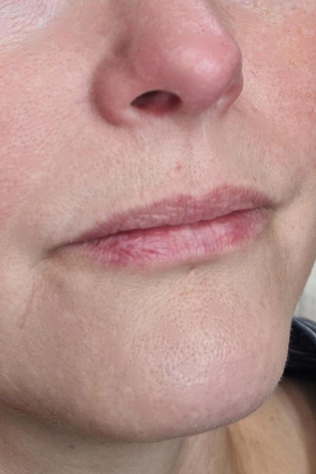 look before Lip Tattoo treatment