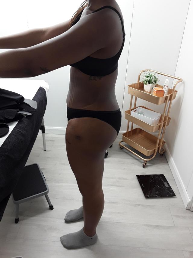 look before Lymphatic Drainage Massage treatment