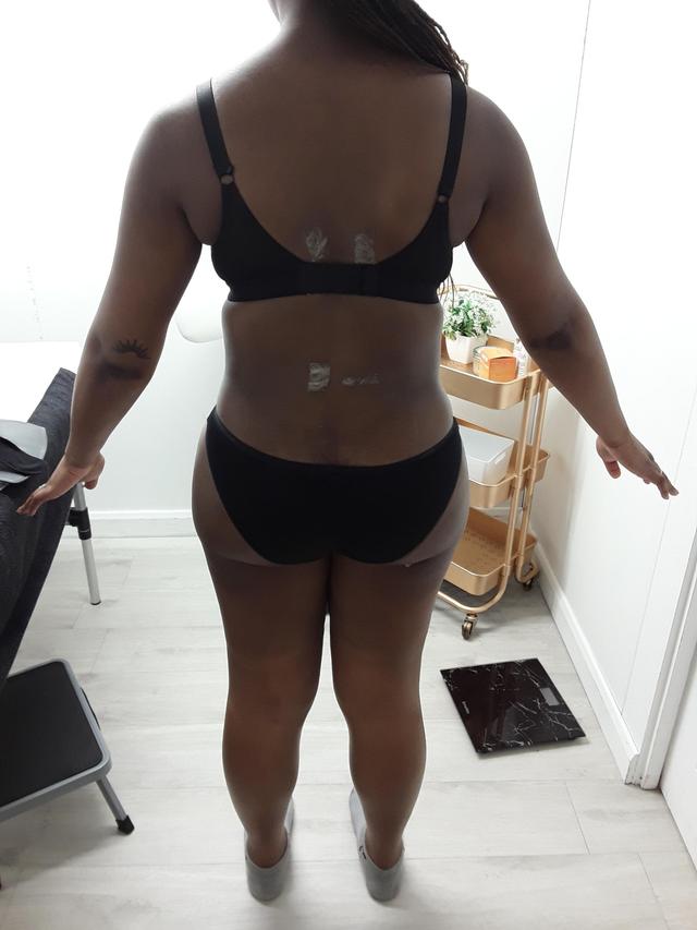 before Lymphatic Drainage Massage treatment