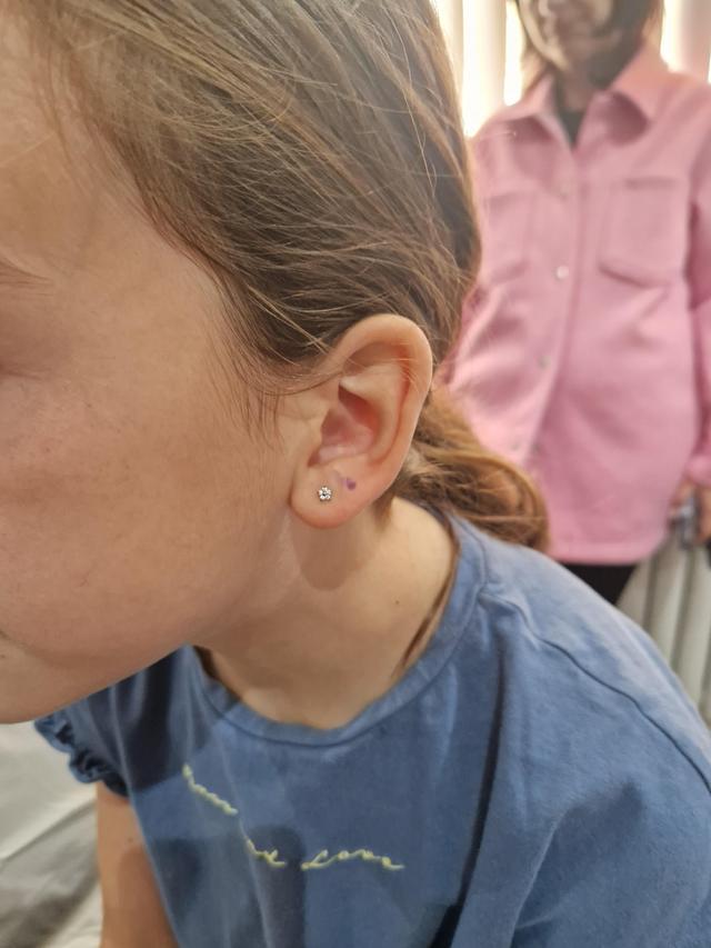 before Ear Piercing treatment
