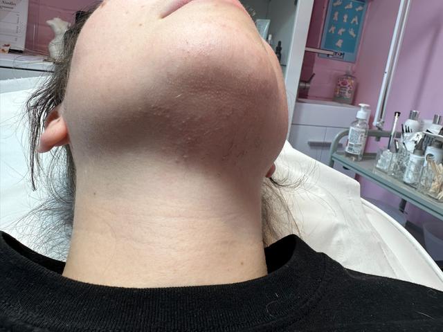 before Lip Waxing treatment
