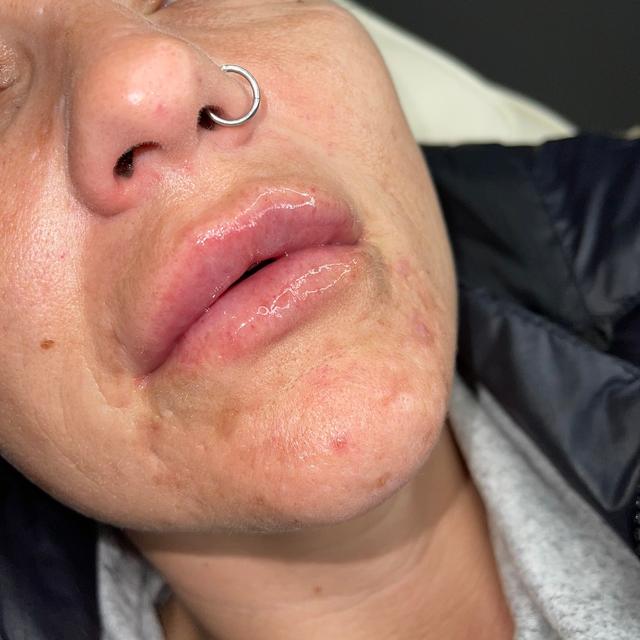 after Lip Filler treatment