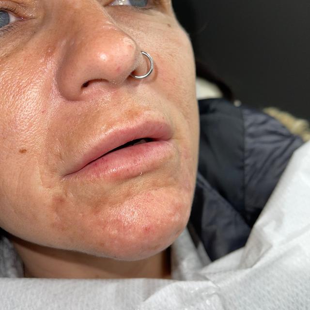 before Lip Filler treatment