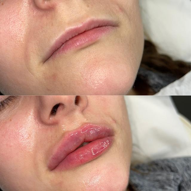 look after Lip Filler treatment
