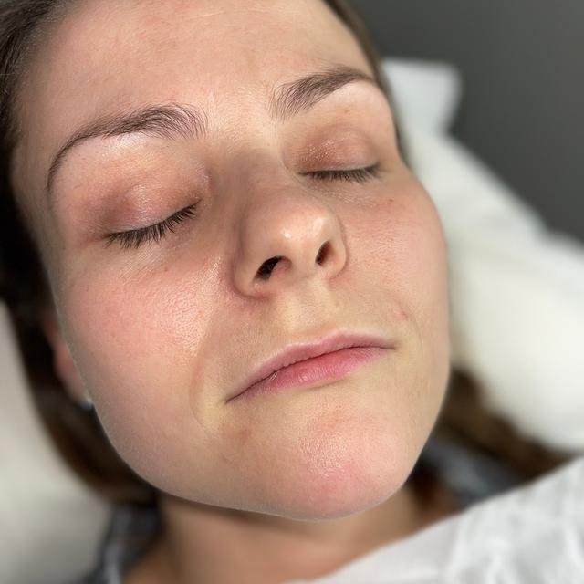 look before Lip Filler treatment