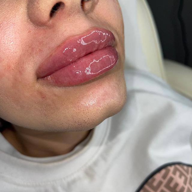 after Lip Filler