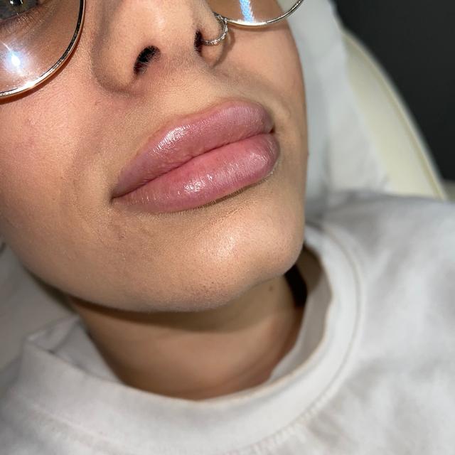 before Lip Filler